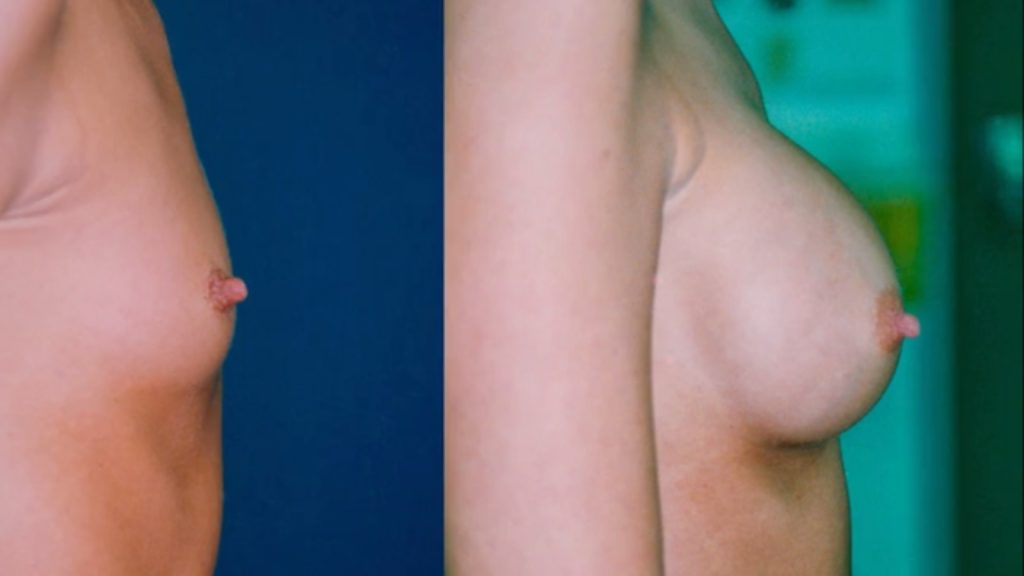 Chirurgie esthétique augmentation mammaire