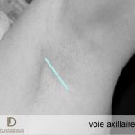 voie axillaire chirurgie mammaire