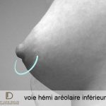 voie hémi aérolaire