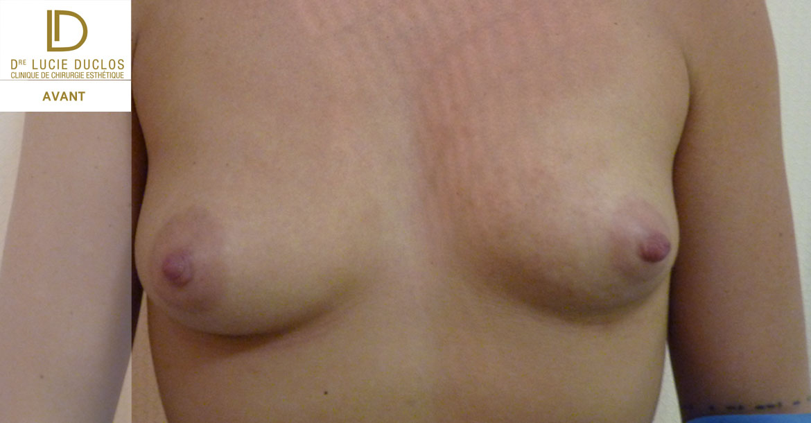 Before-augmentation mammaire