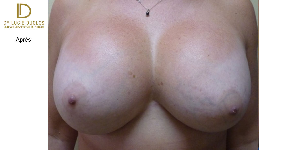 After-augmentation mammaire bilatérale avec implants en silicone UHP de 650 ml (Ultra high profile)