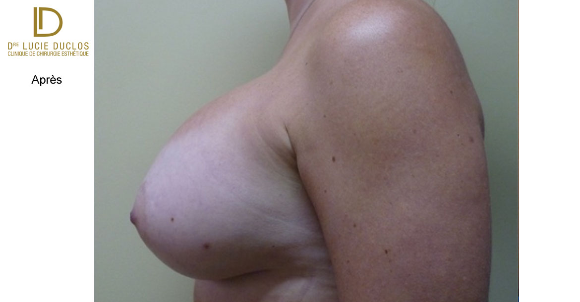 After-Profil Gauche augmentation mammaire bilatérale avec implants en silicone UHP de 650 ml (Ultra high profile)
