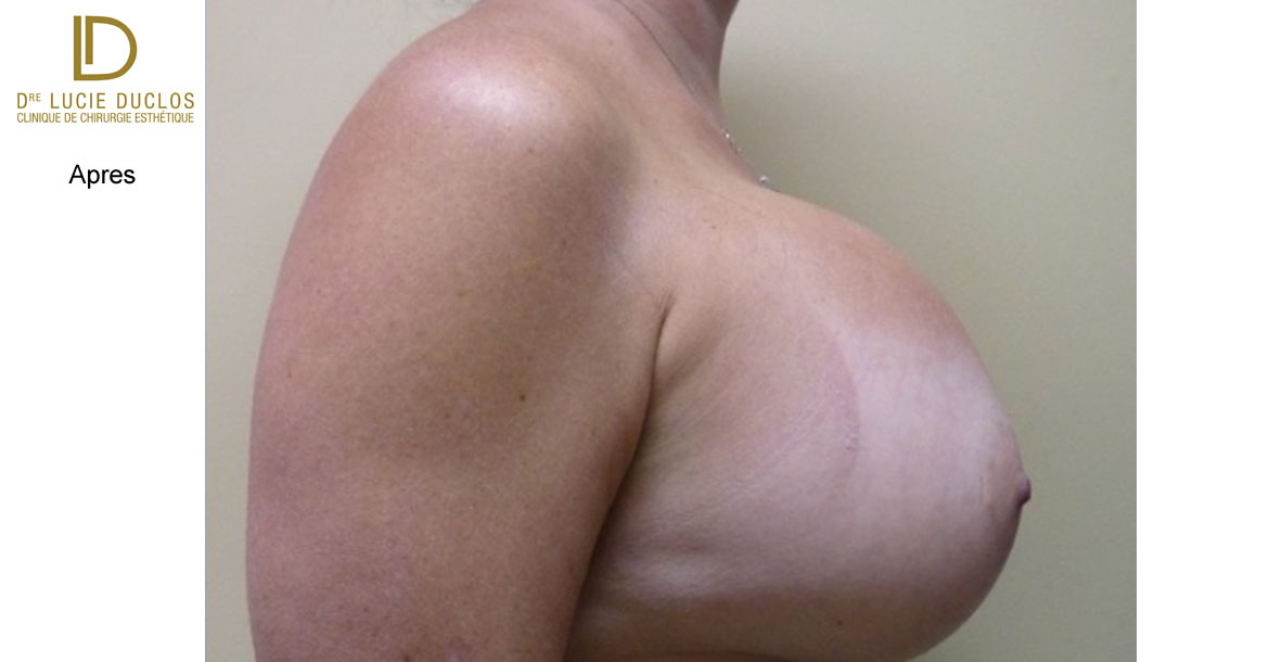 After-Profil Droit augmentation mammaire bilatérale avec implants en silicone UHP de 650 ml (Ultra high profile)