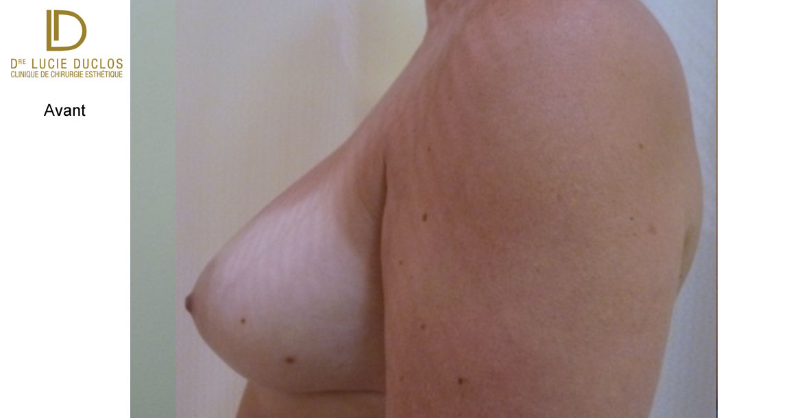 Before-Profil Gauche augmentation mammaire bilatérale avec implants en silicone UHP de 650 ml (Ultra high profile)