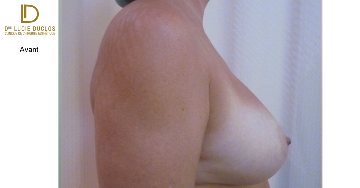 Before-Profil Droit augmentation mammaire bilatérale avec implants en silicone UHP de 650 ml (Ultra high profile)