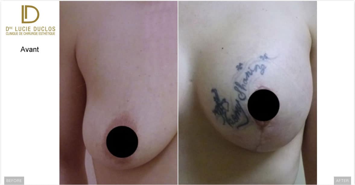 Lollipop breast lift and augmentation UHP 375 ml