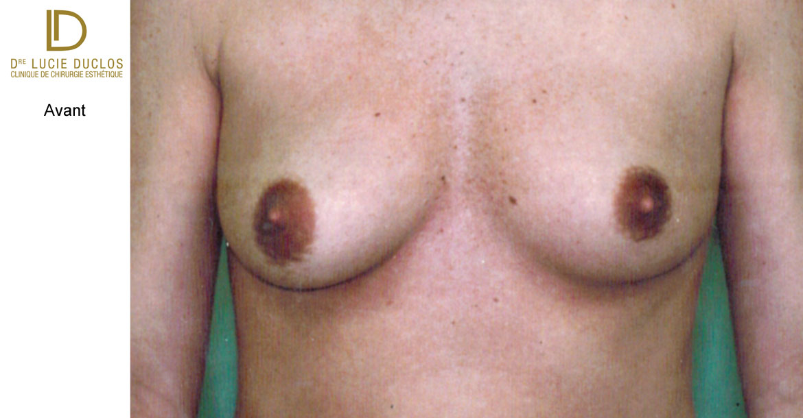 Before-Asymétrie mammaire