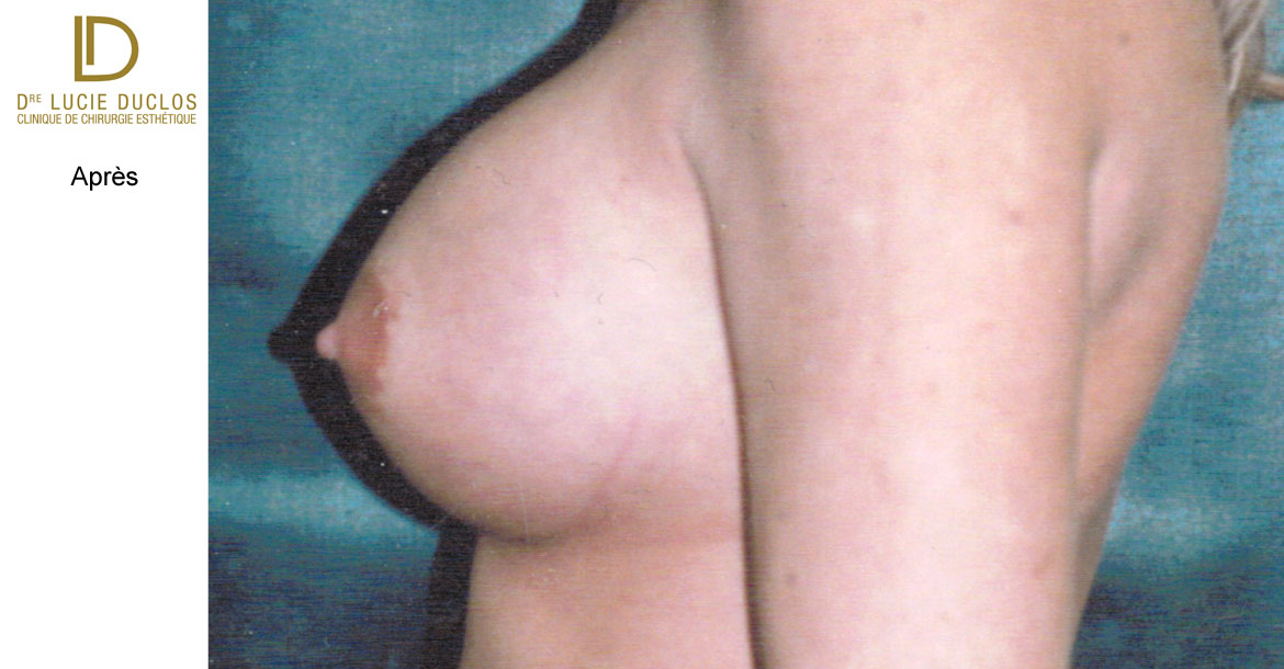 After-Asymétrie mammaire