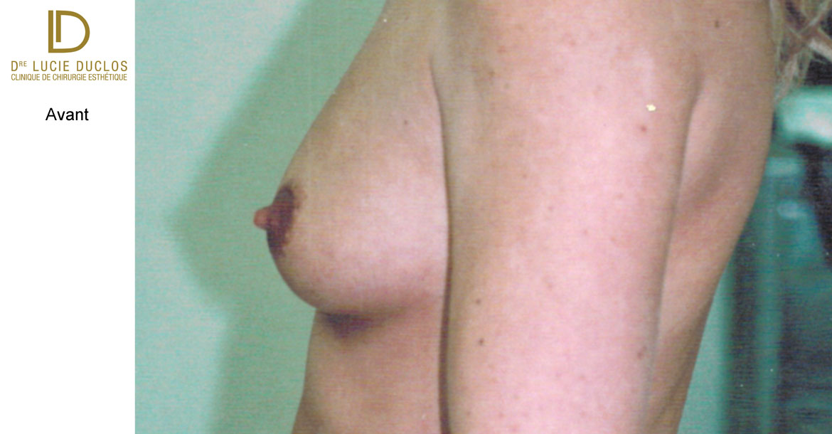 Before-Asymétrie mammaire