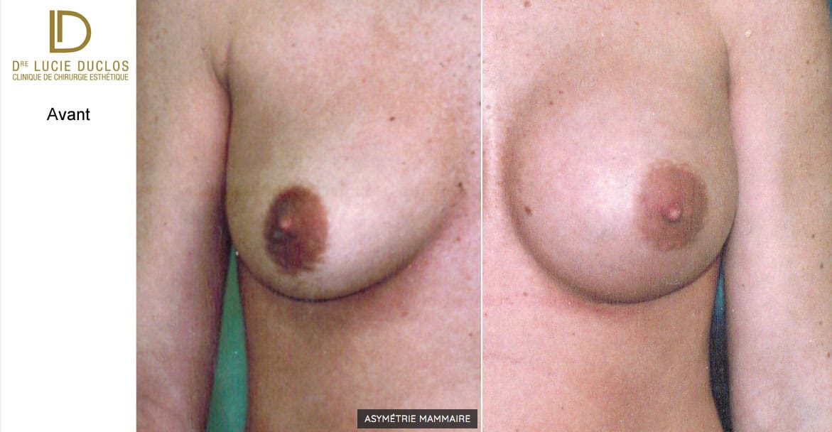 Breast asymmetry High Profile