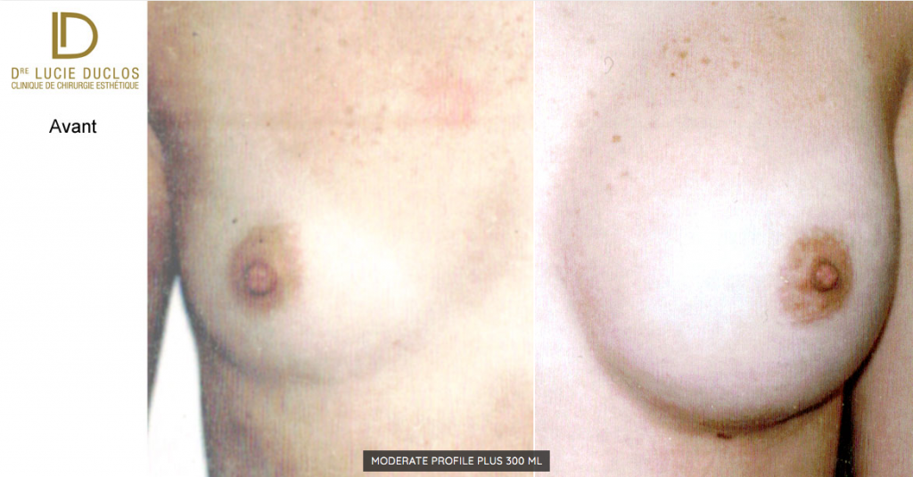 Before after with Moderate Profile Plus implants 300 ml