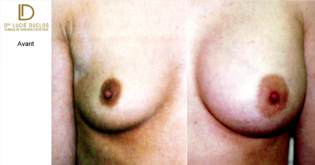 Before After with Moderate Profile Plus Implants 420 ml