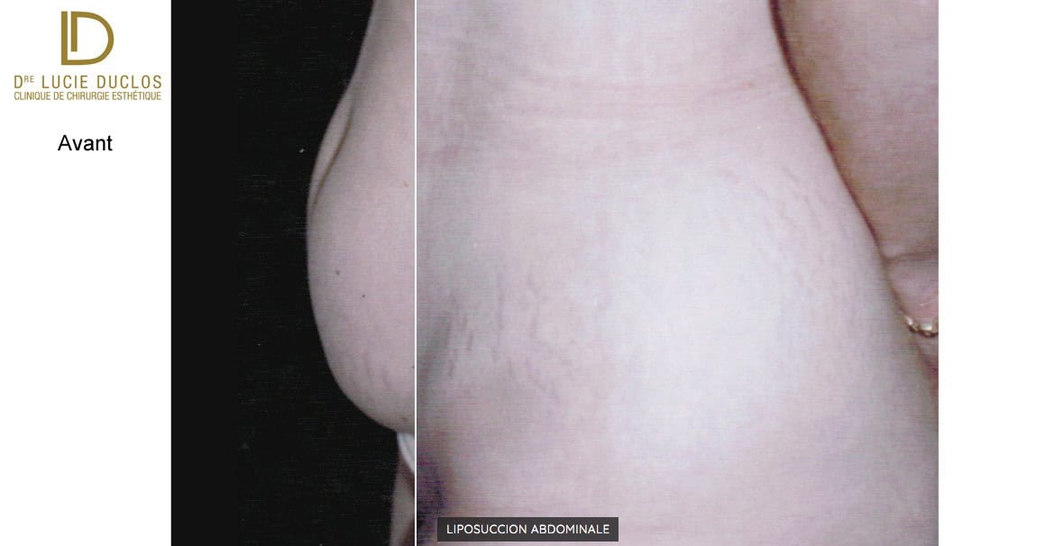 Liposuccion abdominale avant-après