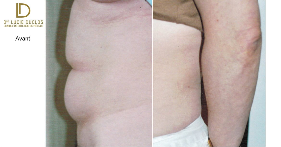 Liposuccion abdominale à la clinique