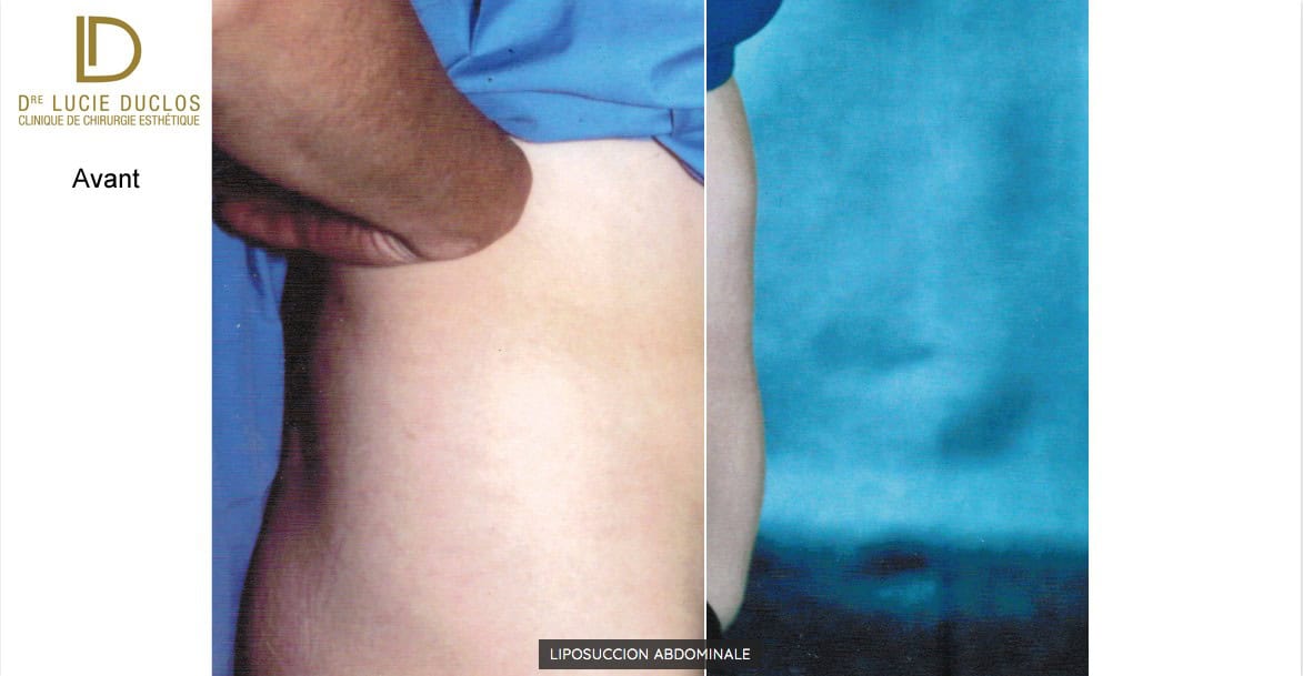 Liposuccion abdominale par Dre Duclos