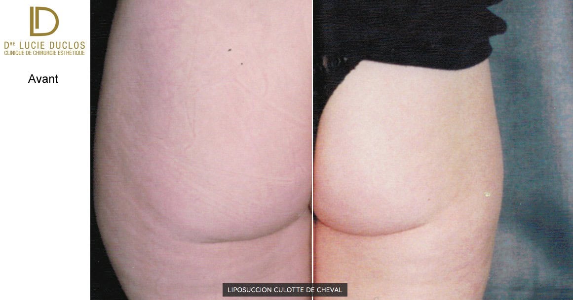 Liposuccion culotte de cheval