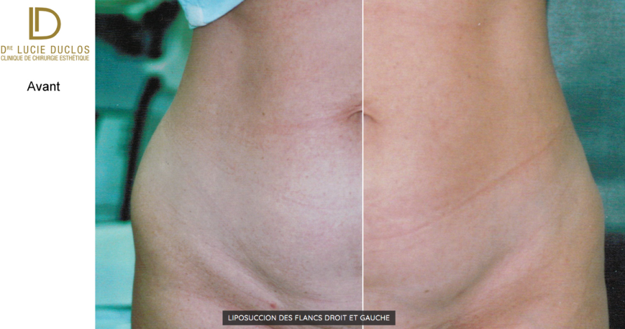 lipossucion des flancs