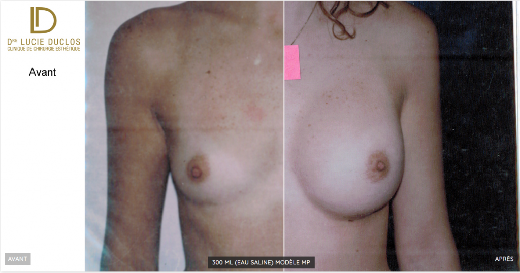 Before after with moderate profile implants with 300 ml saline water