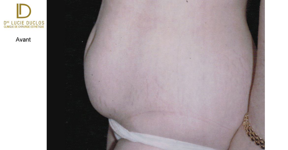 Before-Liposuccion abdominale