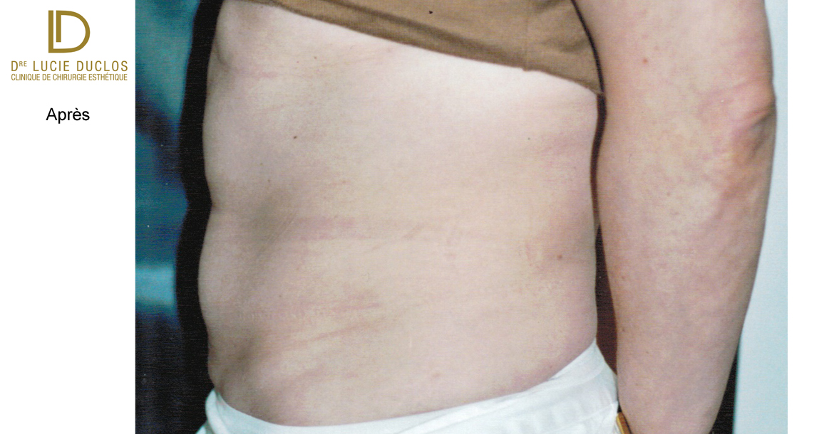 After-Liposuccion abdominale