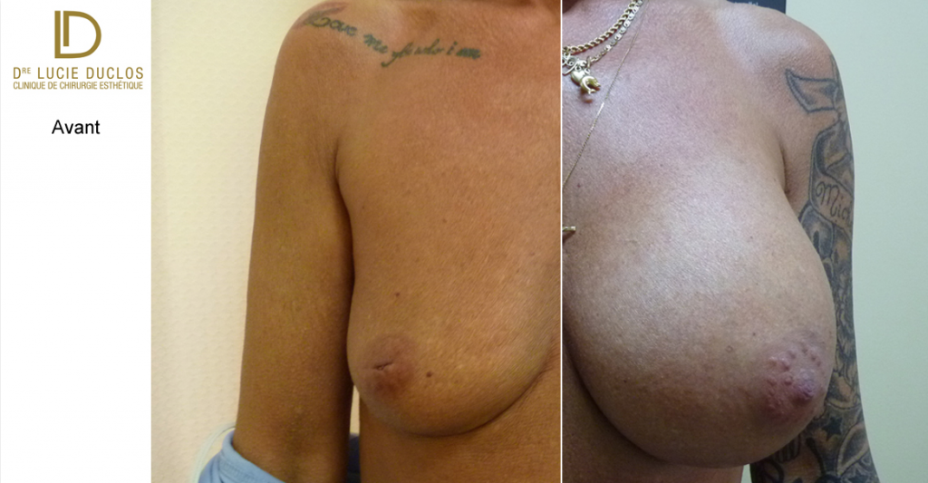 Breast Augmentation de 455 ml silicone UHP