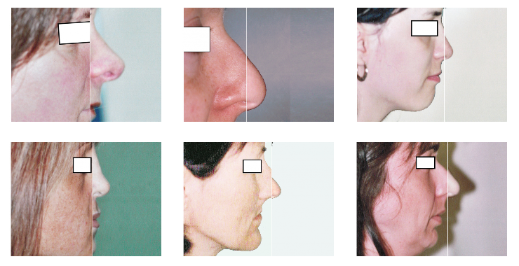 Rhinoplastie et diversité de physionomie du nez en intervention chirurgicale et non chirurgicale