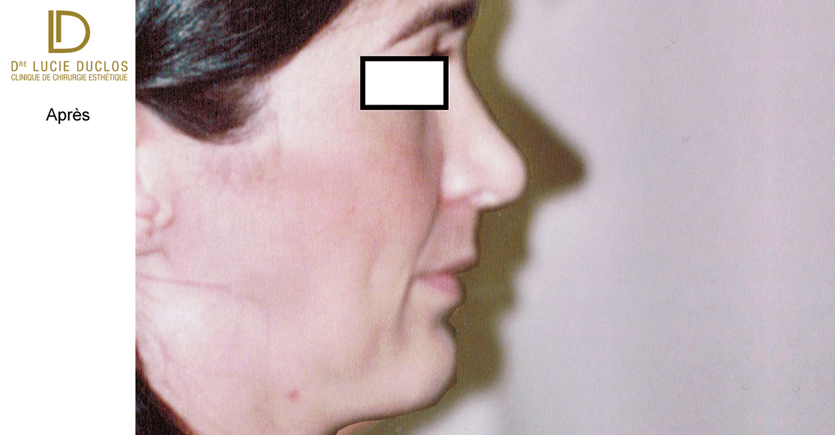 After-6 mois post opération  rhinoplastie