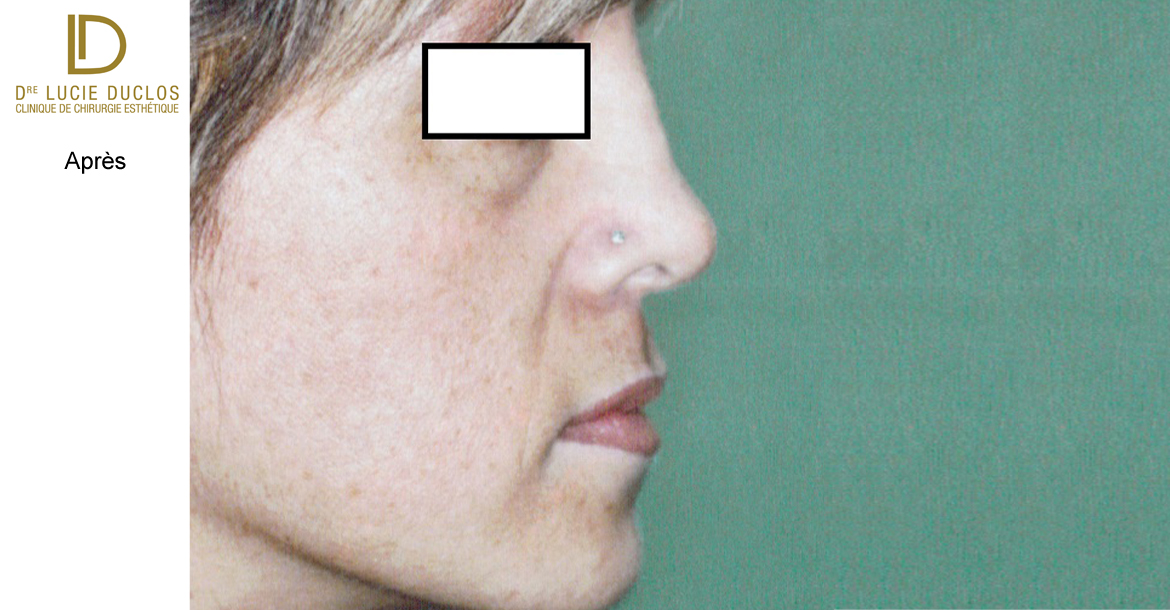 After-6 mois post opération rhinoplastie