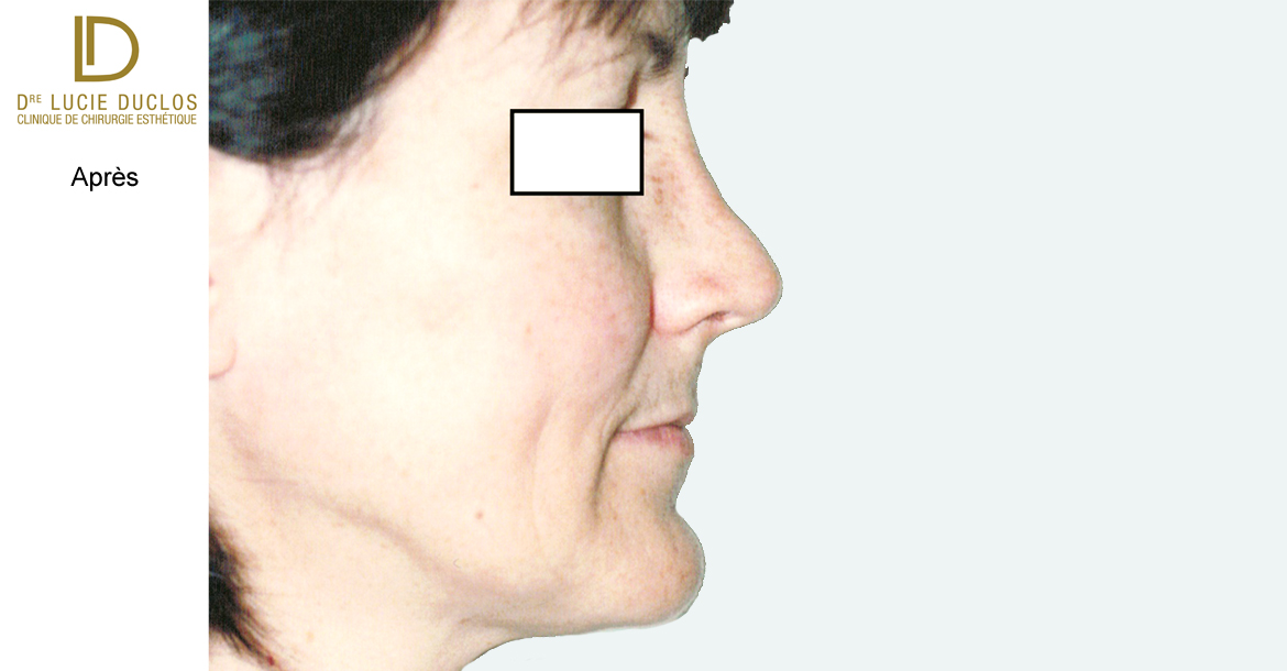 After-6 mois post opération rhinoplastie