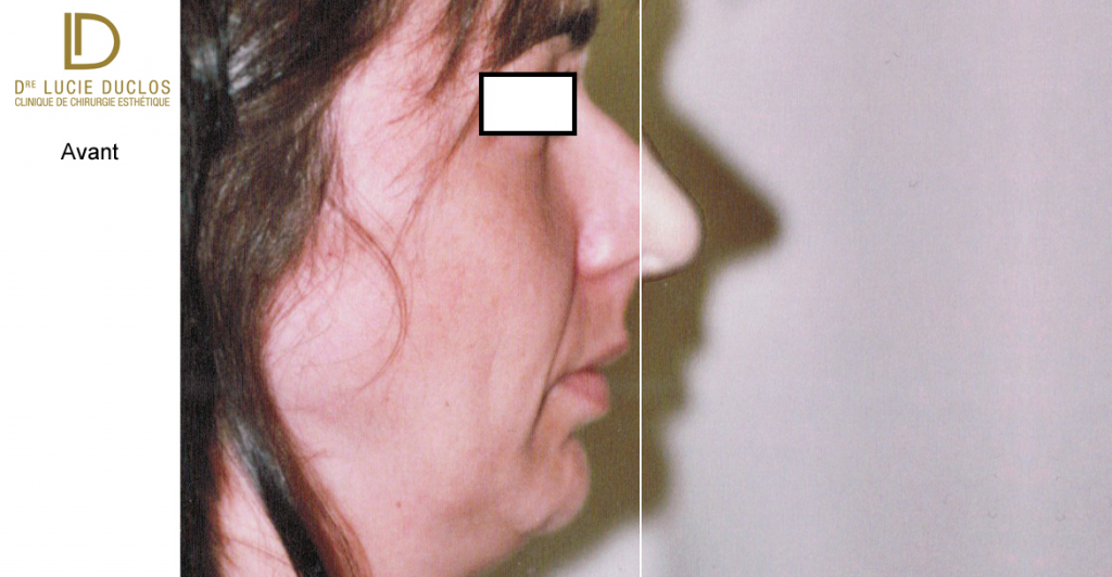 Complete rhinoplasty with chin implant