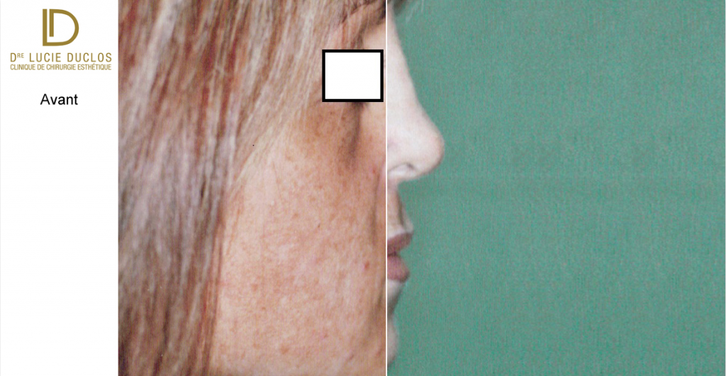 Complete rhinoplasty in plastic surgery