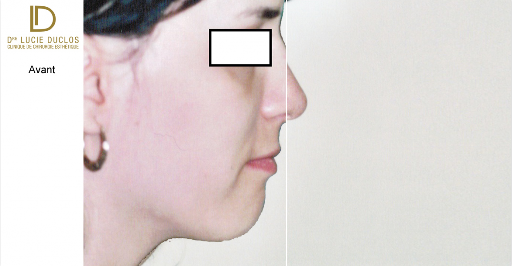 Complete rhinoplasty in cosmetic surgery