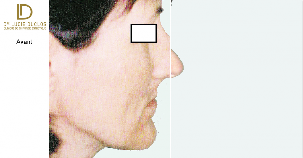 Aquiline nose rhinoplasty