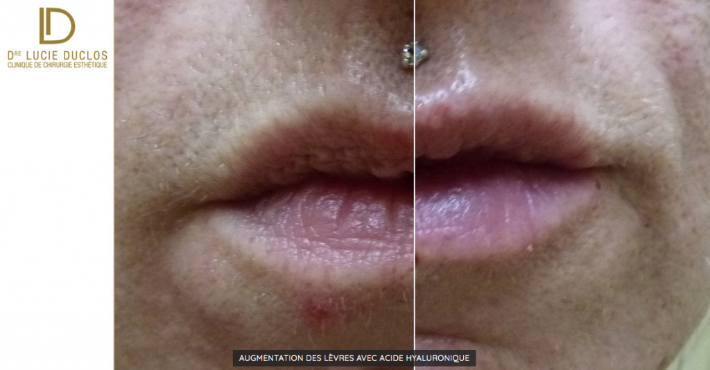 Hyaluronic acid and lip augmentation by injection