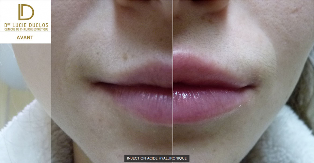 Hyaluronic acid injection for lip augmentation