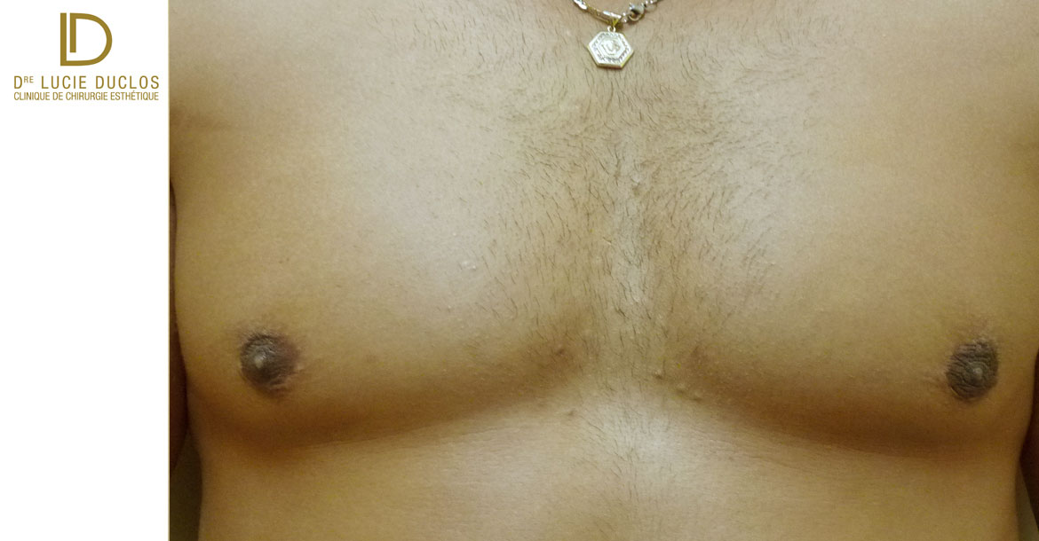After-mastectomie sous cutanée avant après 6 mois