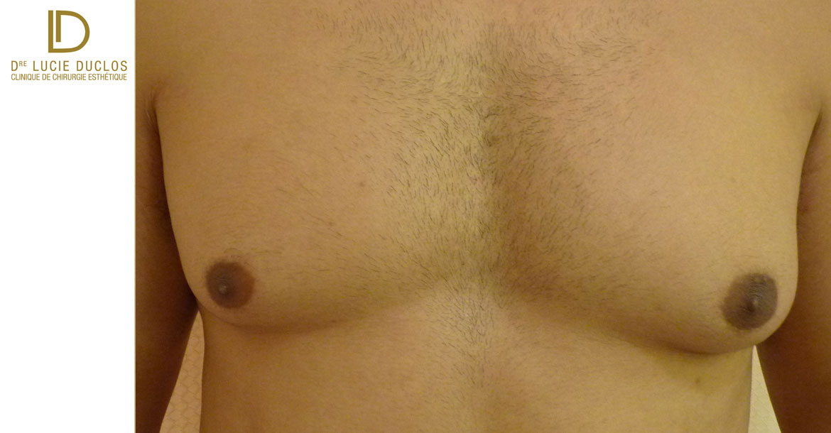 Before-mastectomie sous cutanée avant après 6 mois