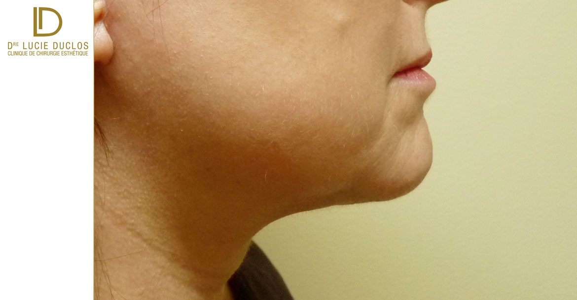 After-redrapage du cou et liposuccion sous mentonnière avant après 6 mois postop