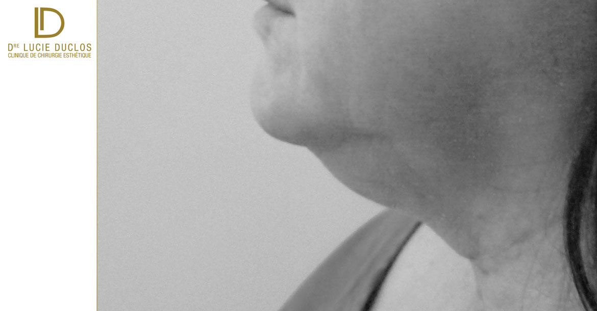 Before-redrapage du cou et liposuccion sous mentonnière avant après 6 mois postop