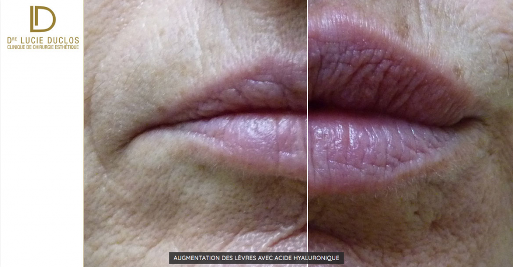 Lip augmentation by injection with hyaluronic acid