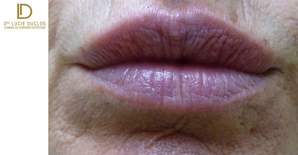 After-Augmentation des lèvres avec acide hyaluronique