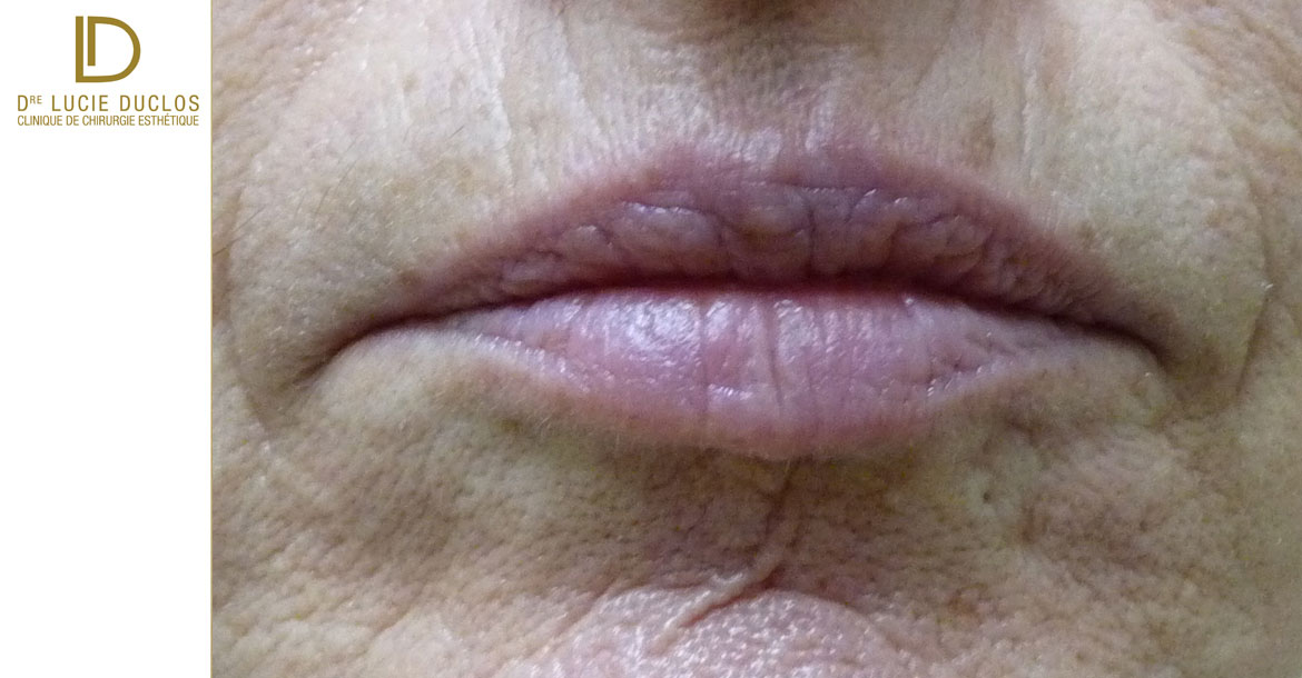 Before-Augmentation des lèvres avec acide hyaluronique