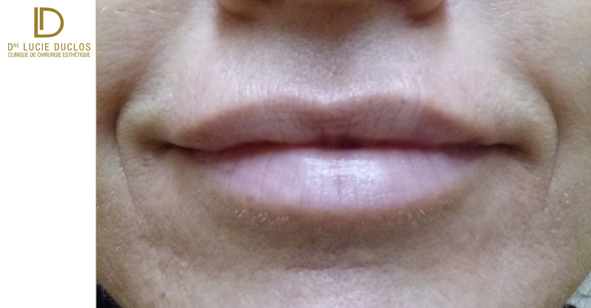 After-Augmentation des lèvres avec acide hyaluronique