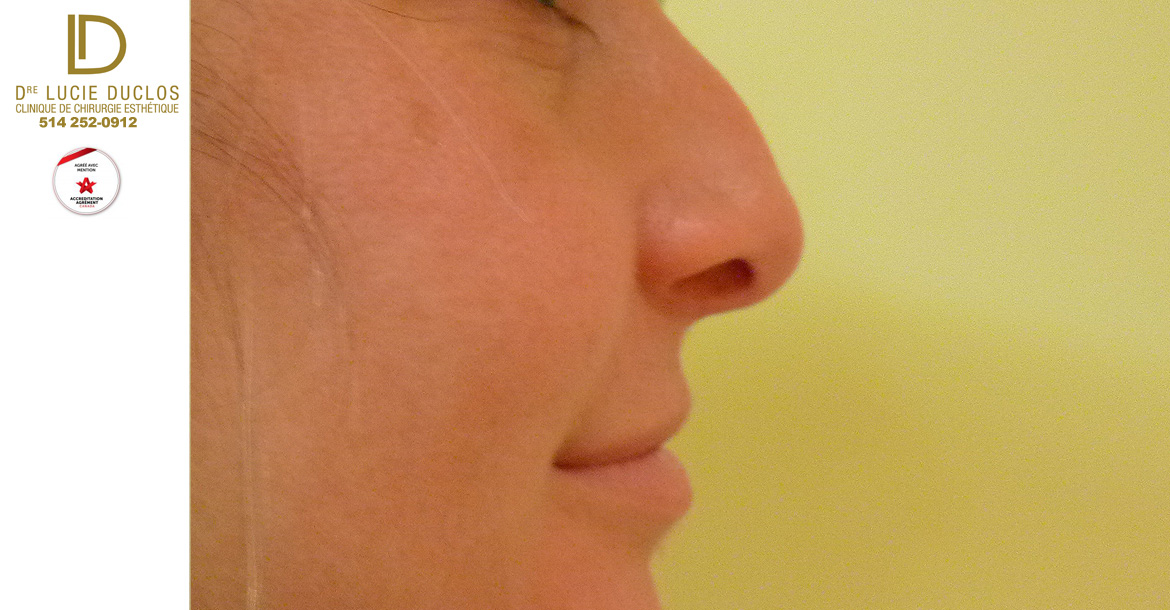 Before-rhinoplastie 1 an post opération