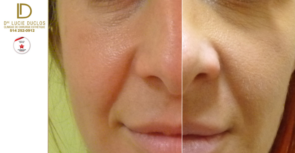 Complete rhinoplasty in plastic surgery