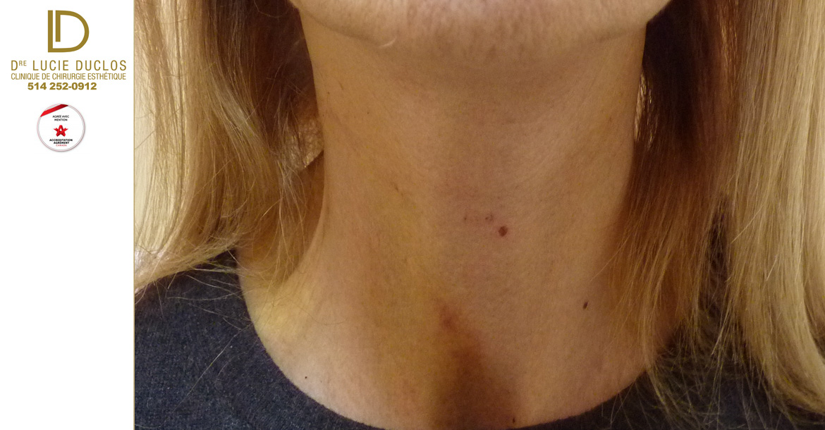 After-Lifting visage femme 1 semaines post opération