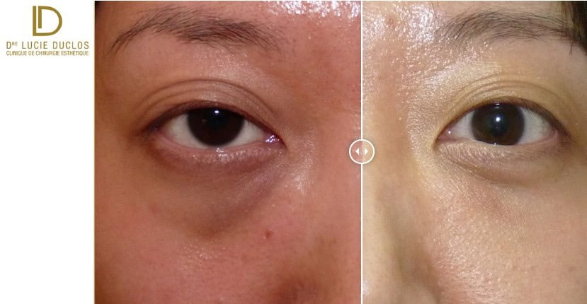 blepharoplastie